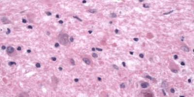 Reactive Astrocytes Reactive Astrocytes on pathology slide