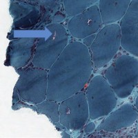 Inclusion Body Myositis Inclusion Body Myositis biopsy with rimmed vacuoles