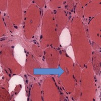Inclusion Body Myositis Inclusion Body Myositis biopsy with rimmed vacuoles