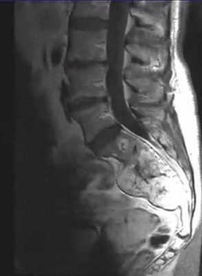 Lumbar spine MRI showing a destructive sacrococcygeal lesion suggestive of chordoma Spinal Chordoma on Lumbar spine MRI, sagittal view