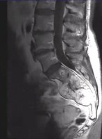 Spinal Chordoma on Lumbar spine MRI, sagittal view