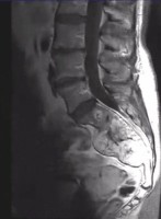Lumbar spine MRI showing a destructive sacrococcygeal lesion suggestive of chordoma Spinal Chordoma on Lumbar spine MRI, sagittal view