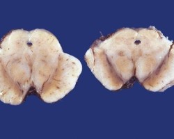Parkinson's Disease Midbrain substantia nigra pathology specimen of patient with Parkinson's Disease