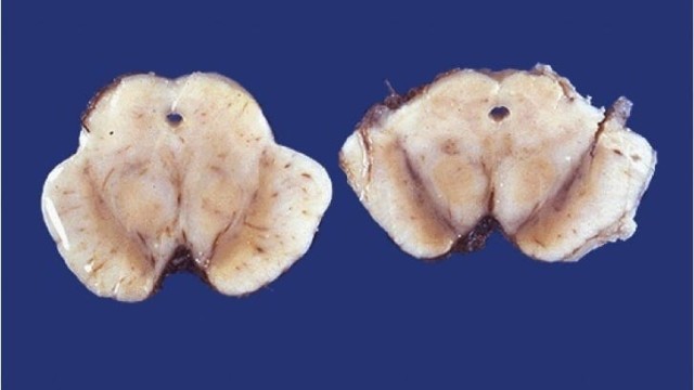 Parkinson's Disease Midbrain substantia nigra pathology specimen of patient with Parkinson's Disease