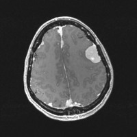 Multiple Meningiomas in NF Type 2 on axial brain MRI