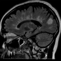 Dawsons Fingers in Multiple Sclerosis on T2 FLAIR MRI