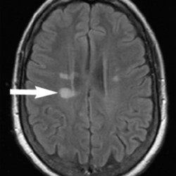 Multiple Sclerosis Plaque Multiple Sclerosis Plaque on MRI brain