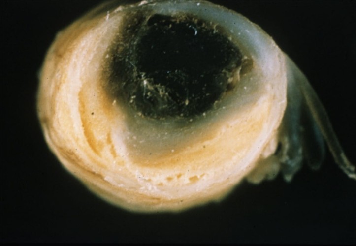 Thrombus in Atherosclerotic Basilar Thrombus in Atherosclerotic Basilar artery on gross neuropathology specimen