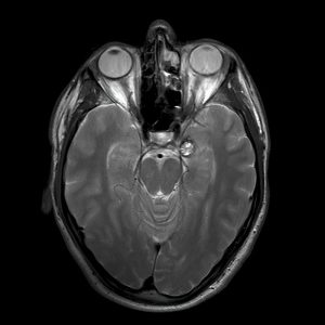 Cavernous Malformation of Axial MRI
