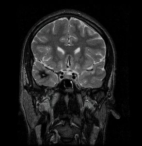Right Temporal Cavernous Malformation on Coronal MRI