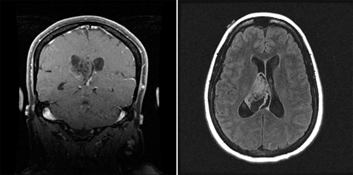 Central Neurocytoma on coronal and axial MRI