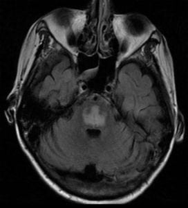 Central Pontine Myelinolysis on T2 FLAIR MRI