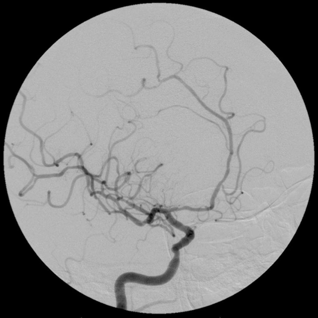 Primary CNS Vasculitis on cerebral angiogram