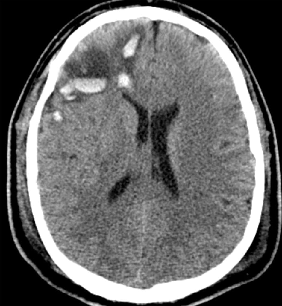 Cerebral Contusion on CT head