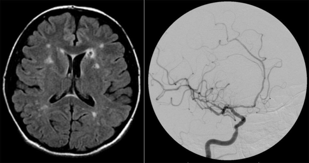 Primary CNS Vasculitis