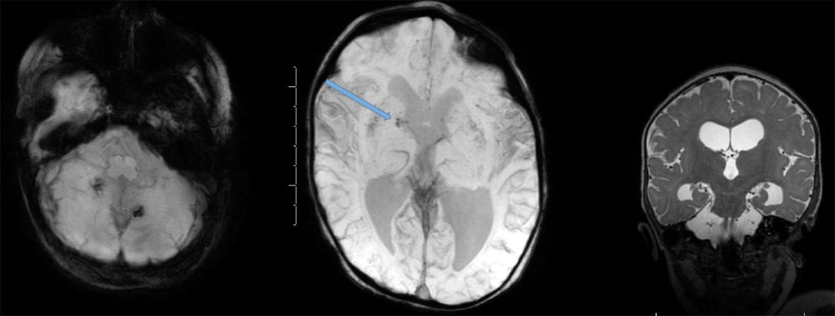 Neuroinfectious disease Congenital CMV MRI periventricular calcifications