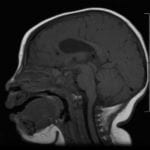 Corpus Collosum Dysplasia on sagittal MRI