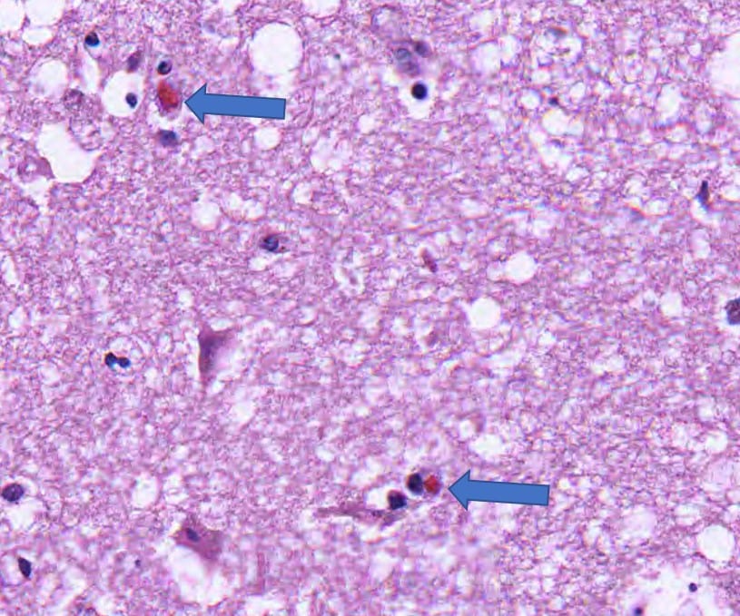 Pathology slide with Cowdry bodies of intranuclear eosinophilic inclusions of nucleic acid