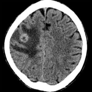Brain Metastasis on axial CT scan