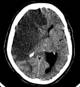Right ICA Infarct with Subfalcine Herniation on CT scan, axial cut