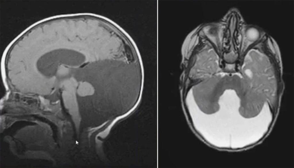 Dandy Walker Cyst on sagittal and axial MRI T2 FLAIR and T1
