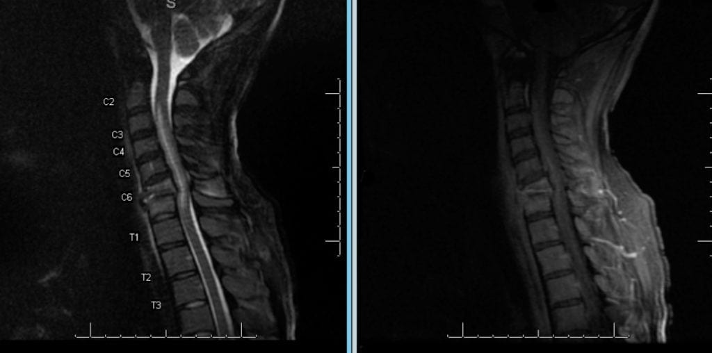 Discitis and Osteomyelitis on Sagittal spine MRI