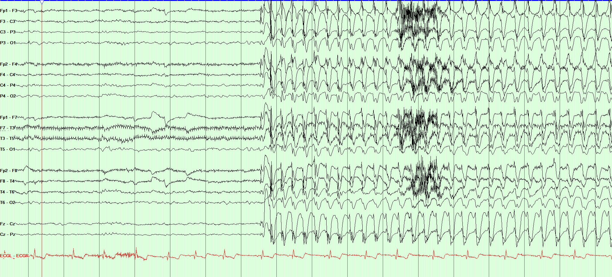 Epilepsy Absence seizure with 3 Hz spike and wave