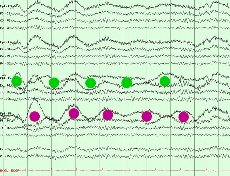 EEG Review