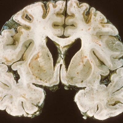 Bilateral ischemia on gross coronal section of brain