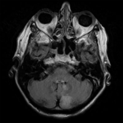 Left PICA Infarct on brain MRI