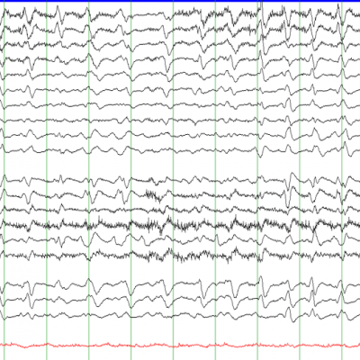 EEG with GPDs with Triphasic Morphology on Average montage, Secondary to hepatic encephalopathy