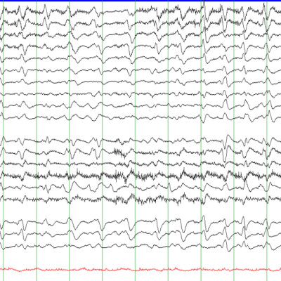 EEG with GPDs with Triphasic Morphology on Average montage, Secondary to hepatic encephalopathy