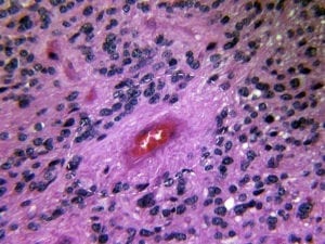 H&E stain of Ependymoma showing fibrillary processes surrounding a vessel, creating a clearing between the tumor nuclei and the vessel, described as a perivascular pseudorosette