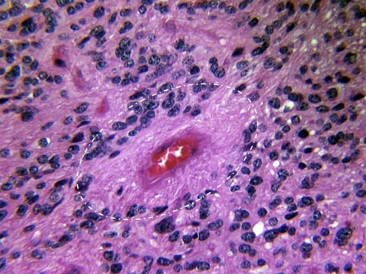 H&E stain showing fibrillary processes surrounding a vessel, creating a clearing between the tumor nuclei and the vessel, described as a perivascular pseudorosette