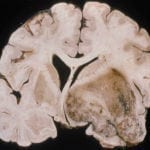 Glioblastoma Multiforme