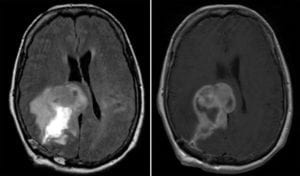 Glioblastoma Multiforme on axial brain MRI T2 FLAIR and T1 with contrast