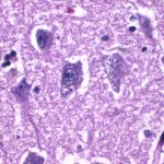 granulovacuolar-degeneration-alzheimers-disease-1.jpg