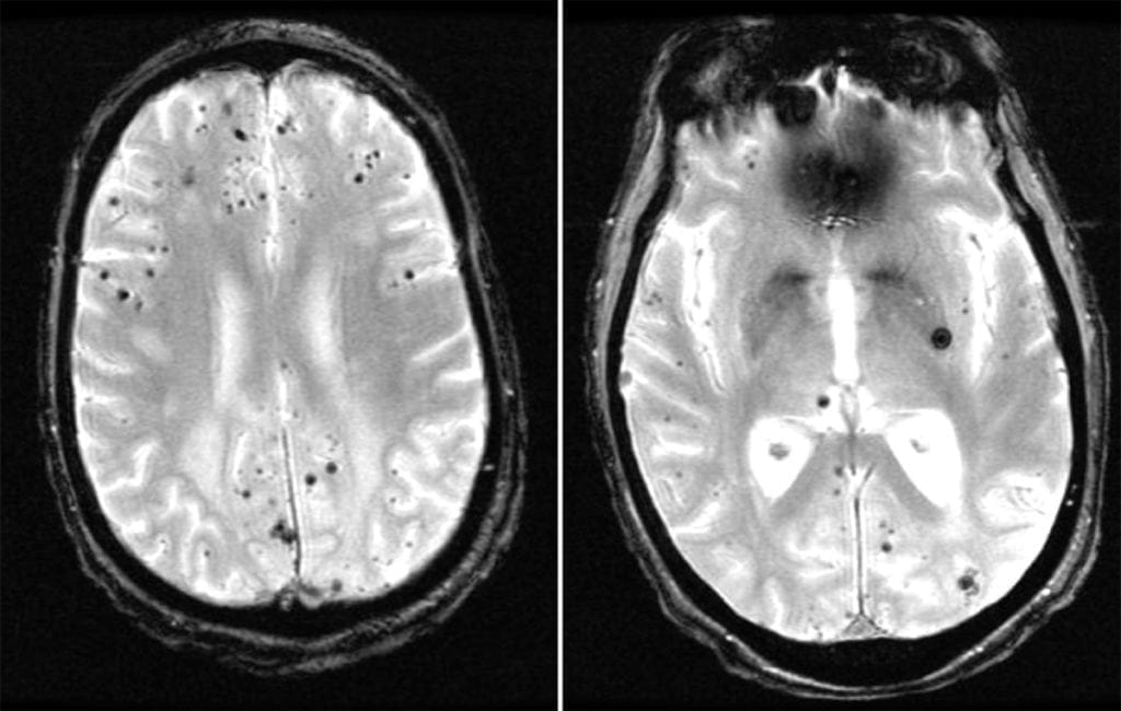 Cerebral Amyloid Angiopathy on MRI GRE