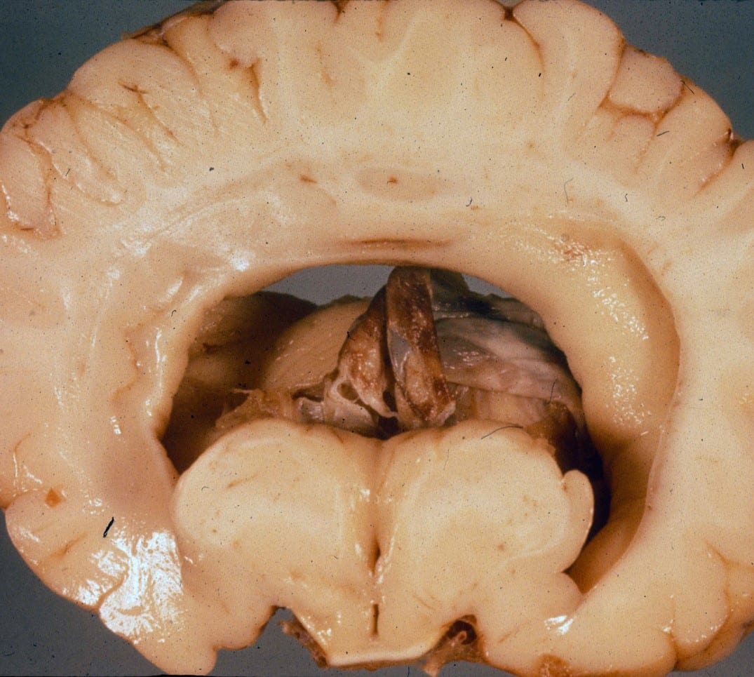 Coronal section of the brain showing alobar holoprosencephaly.