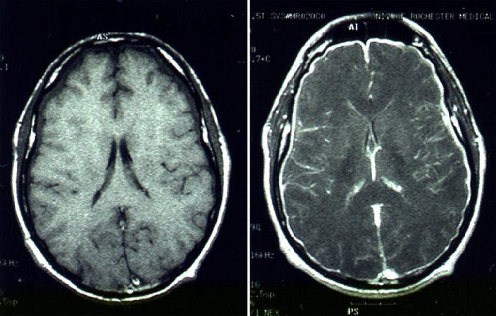 Pachymeningitis on MRI brain