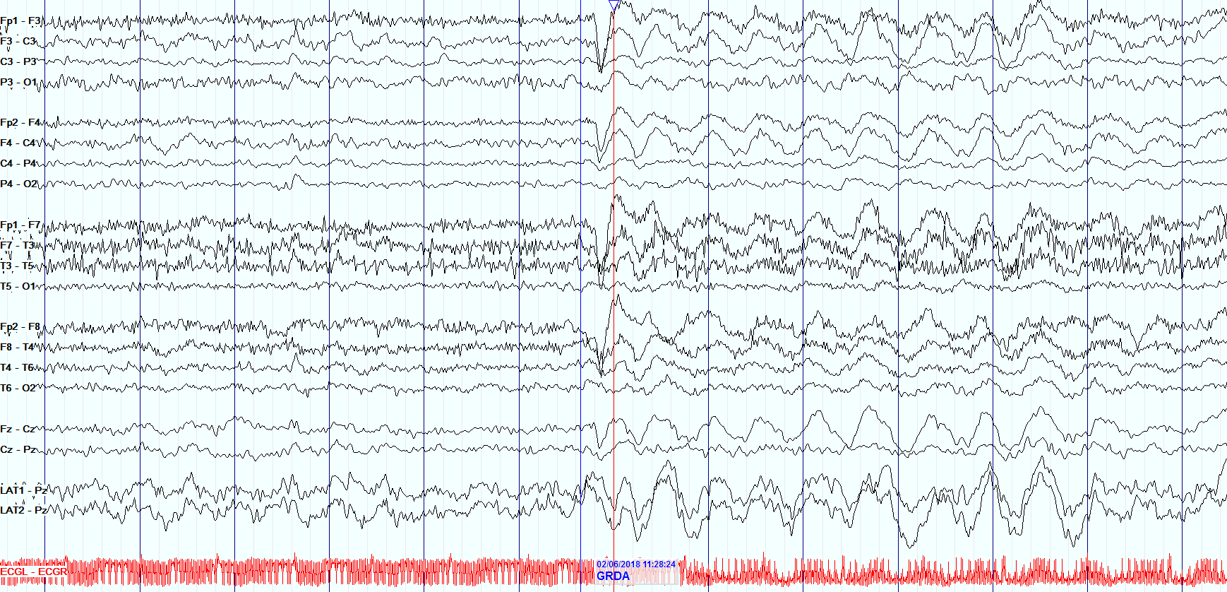 Learn to Read EEG , with practice questions! | NowYouKnow Neuro