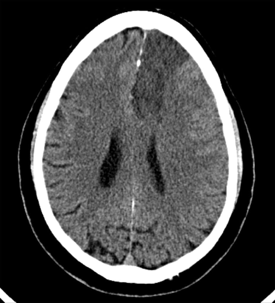 Chronic Left ACA Infarct on axial head CT