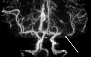 L MCA Occlusion