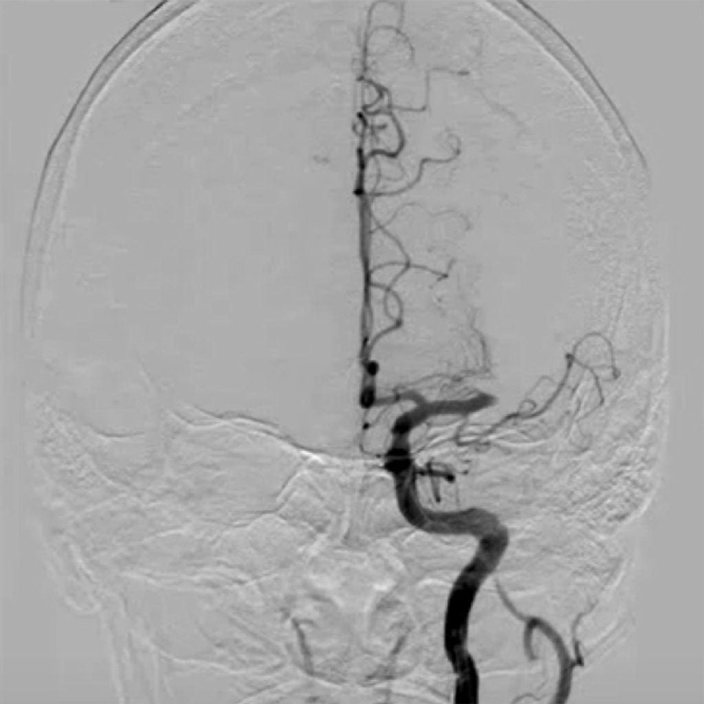 Left MCA Occlusion on cerebral angiogram