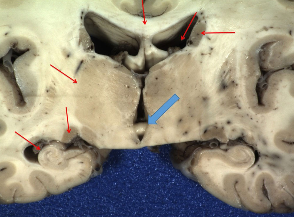 Gross pathology coronal section brain with arrow labeled structures