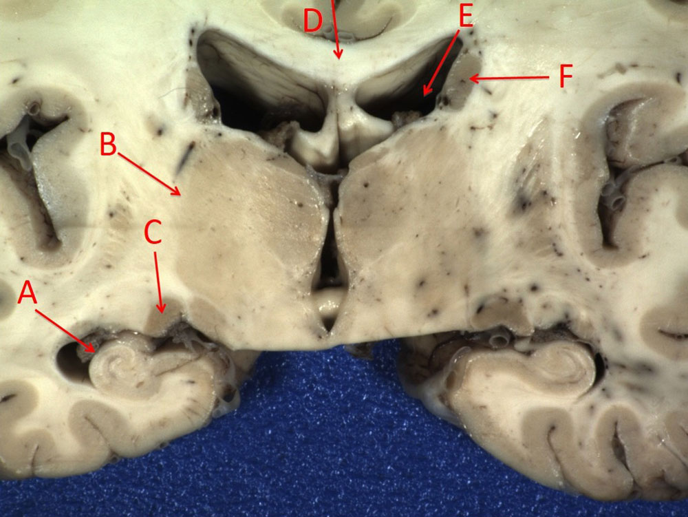 Gross pathology coronal section brain with labeled structures