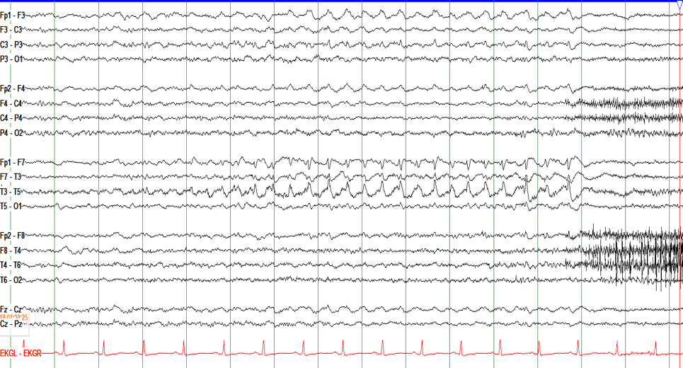 EEG tracing showing a left temporal seizure