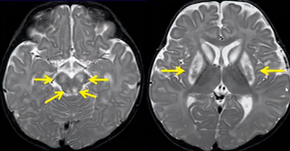 Leigh syndrome, hyperintensities of the cerebral peduncles and basal ganglia on T2 sequences