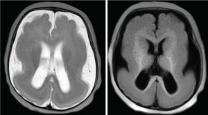 lissencephaly t2 and t1 MRI