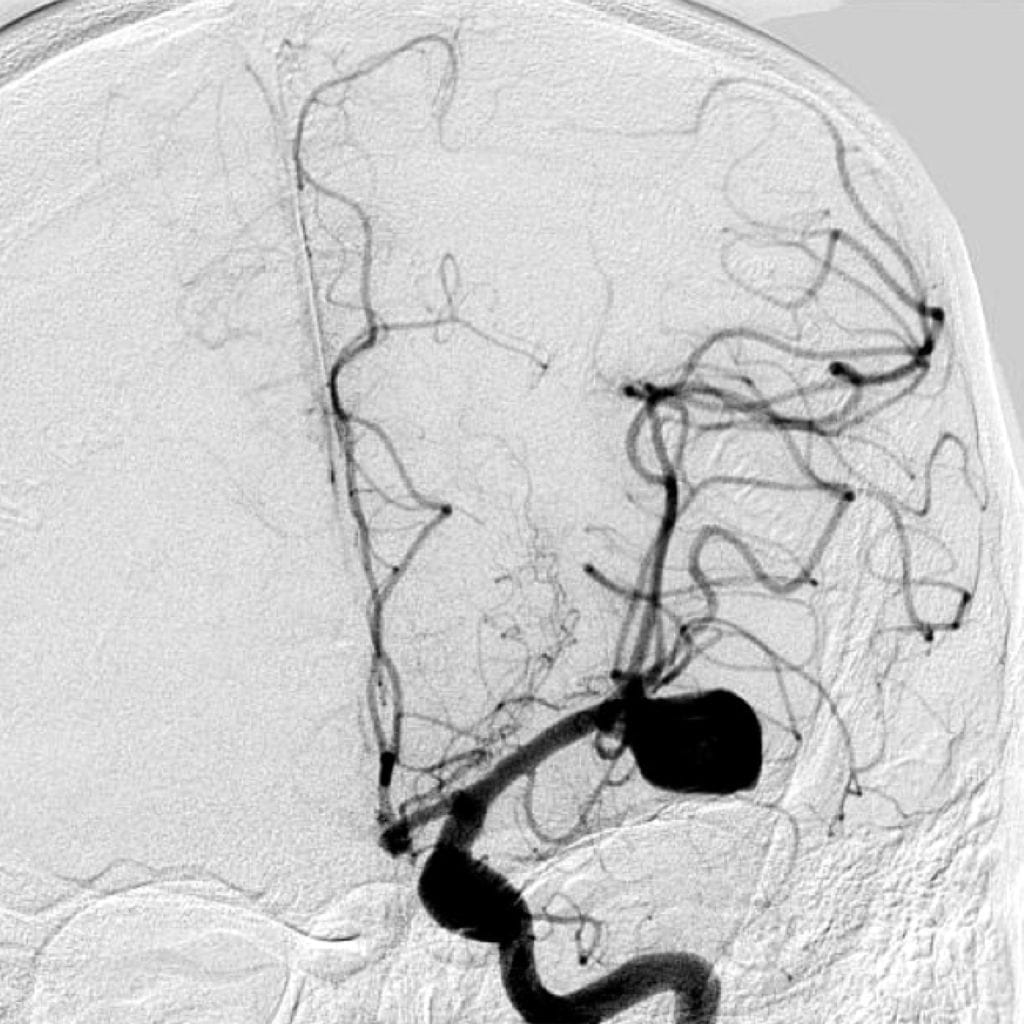 MCA Aneurysm on cerebral angiogram